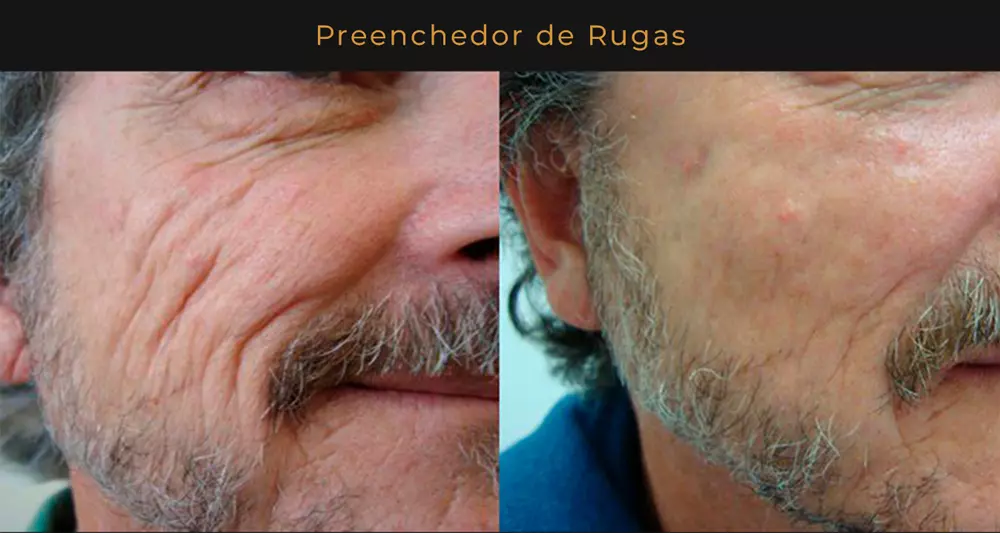 Hidra Pele Preenchedor de Rugas